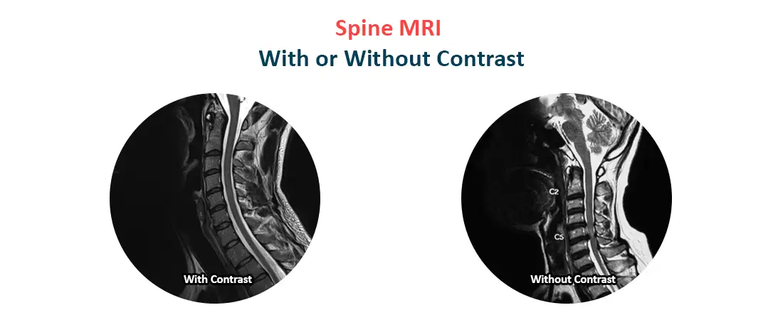 Spine MRI With or Without Contrast